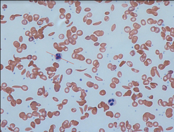 Sickles Cell Anemia under microscope
